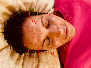Cosmetic Acupuncture:  The Natural Alternative to Botox