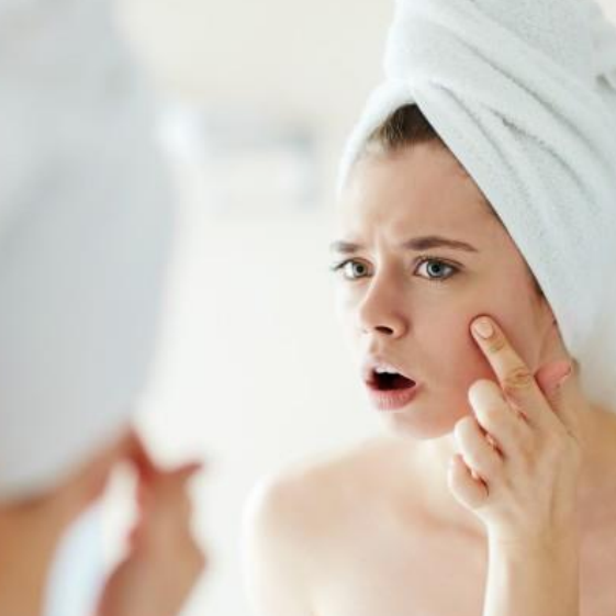 Surprising things that cause acne