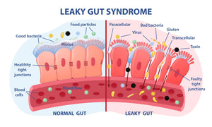 Leaky Gut Syndrome:  Symptoms, Causes, and Treatments