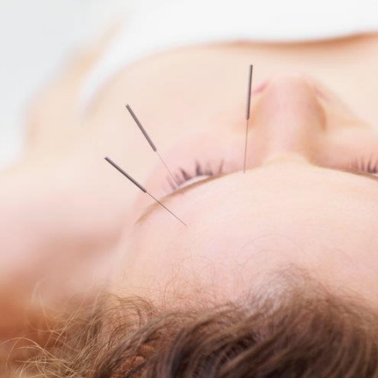 I Tried Facial Acupuncture- and it was Amazing!